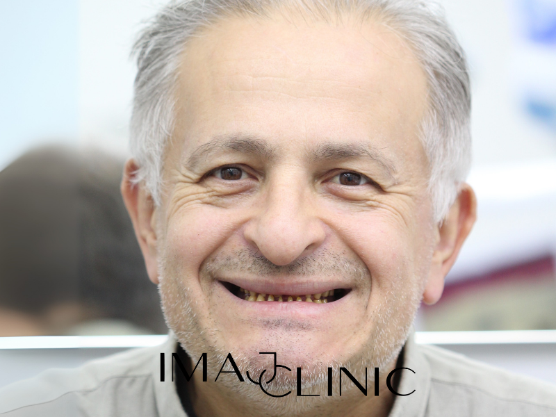 Tedavi Öncesi